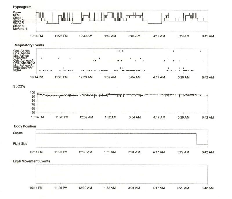 Sleep Study Results Normal